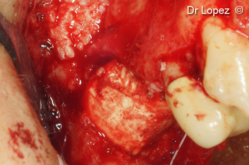 6. Curved lamina stabilized by the two slots and containing mixed graft of GTO and scraped bone in ratio 50% 