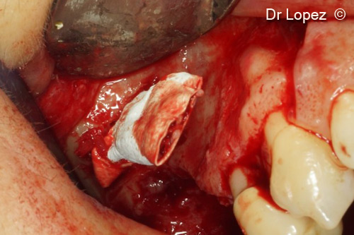 Lateral sinus pack and crestal bone...