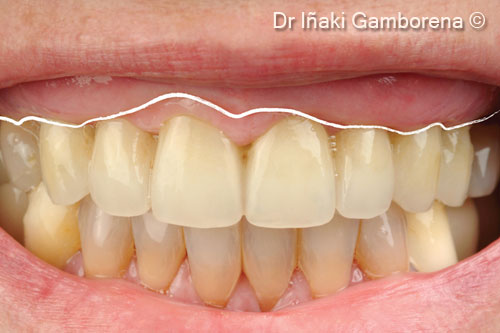 8. Provisional restoration connection. Notice the absence of keratinized mucosa and the incisal position of the mucogingival line on a high lip smile line