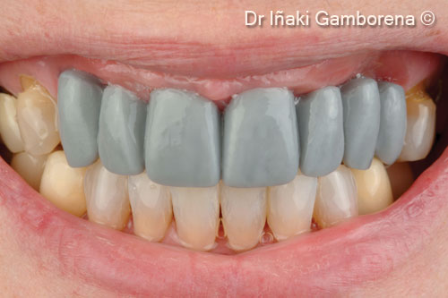 2. Full contour wax-up demonstrating the horizontal and vertical bone loss deficiency on posterior areas