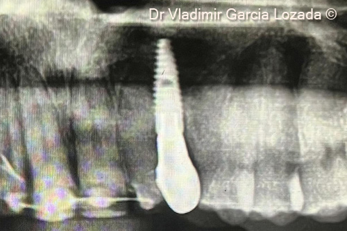 Fig.18. Radiograph X-ray with final restoration