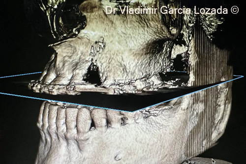 Fig. 3. CBCT bone defect in site #23