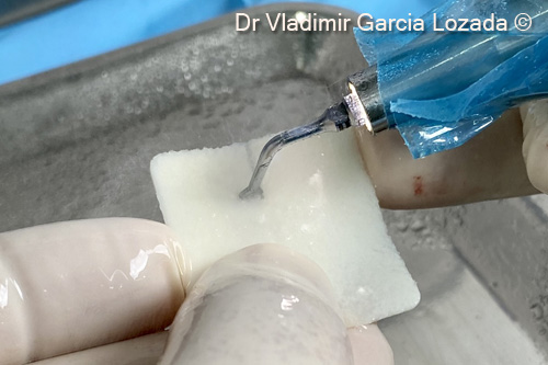 Fig. 7. Preparation of the OsteoBiol® cortical <i> Lamina® </i> using a piezosurgery device