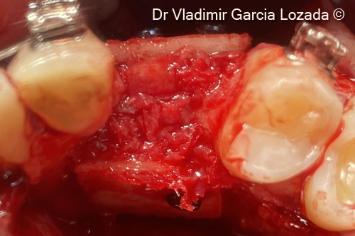 Fig.13. Axial clinical view of the bone augmentation before flap closure
