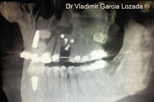 Fig.15. CBCT post-op lateral view