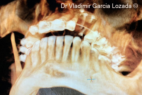 Fig.16. CBCT post-op axial view