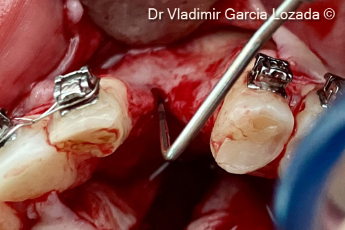 Fig. 6. Axial clinical view of the three-dimensional defect