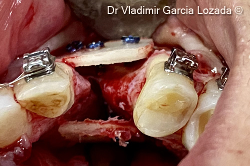 Vertical and horizontal bone...