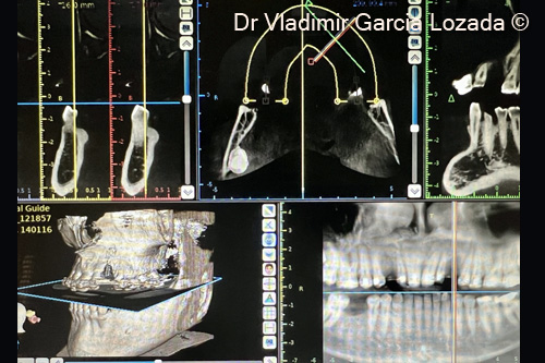 Fig. 2. CBCT pre-op initial situation