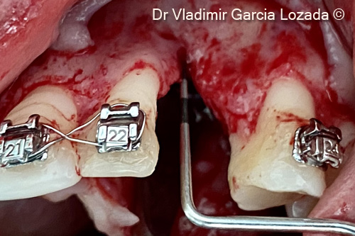 Fig. 4. Degloving of a full thickness flap observing the three-dimensional defect in site #23