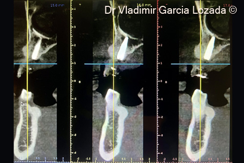 Fig.17. CBCT 9 month after implant placement in site #23 with relining procedure recommended in this cases