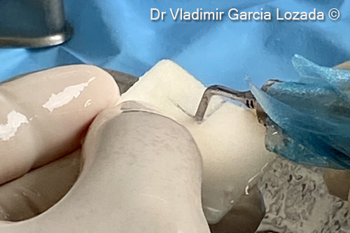 Fig. 8.  Preparation of the OsteoBiol® cortical <i> Lamina® </i> according to the size of the bone defect site