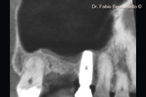 Fig. 1 Pre-surgical radiograph. An implant was inserted to replace tooth #16 about 10 years before. The implant subject to this case was placed in position #17