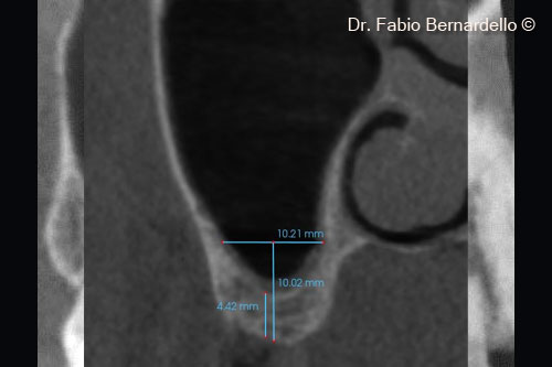 Fig. 2 The narrow anatomy of the sinus ( < 12 mm in width measured at 10 mm from the maxillary ridge) and residual bone height between 3 mm and 5 mm allowed a 1-stage surgical approach (crestal sinus lift and contextual implant insertion)
