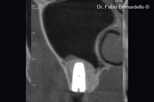 Fig. 5 Cross-section CBCT at baseline (T0). OsteoBiol® Gel 40 elevated the sinus membrane in the site of the new implant and also above the apex of the old implant in position 16