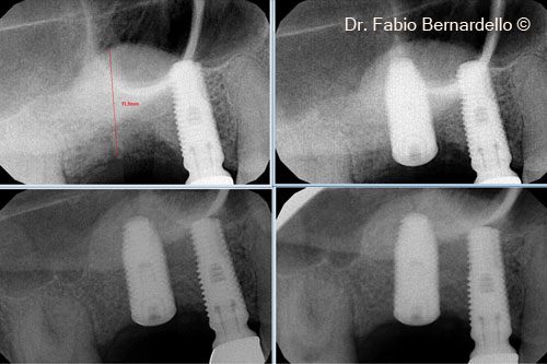 Fig. 6 Intraoral radiographs: intraoperative and at T0, 2 months, 5 months