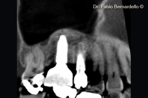Fig. 10 Follow-up radiograph after one year of prosthetic load