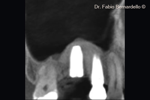 Fig. 4 Panorex at baseline (T0). OsteoBiol® Gel 40 elevated the sinus membrane in the site of the new implant and also above the apex of the old implant in position 16