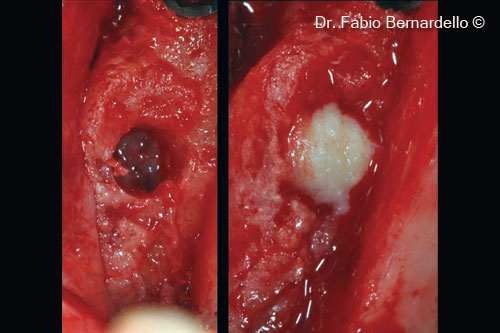 One-stage crestal sinus lift with...