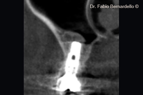 Fig. 8 Radiograph 7 months after surgery, OsteoBiol® Gel 40 has been remodeled into new bone above the implant inserted 10 years before 