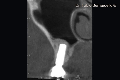 Fig. 7 Radiograph 7 months after surgery, OsteoBiol® Gel 40 has been remodeled into new bone above the new implant