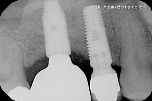 Fig. 9 One year after surgery. Observing the radiograph, it’s difficult to identify the transition between pristine and newly formed bone
