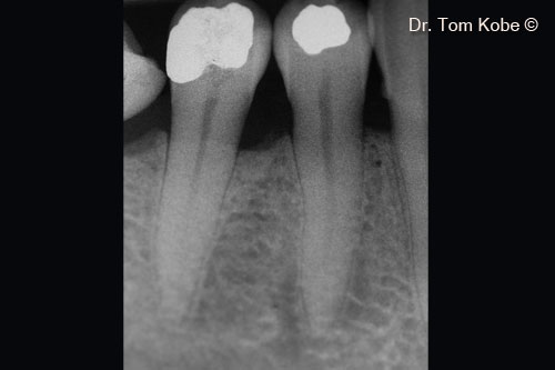 Fig. 11 Radiograph 1 year after treatment
