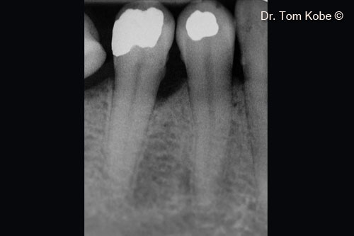 Fig. 2 Vertical bone defect on the radiograph