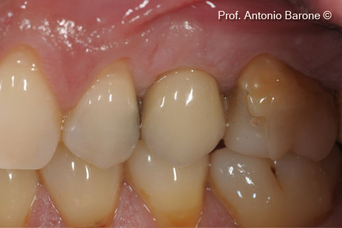 Fig.23 Buccal View 3 years after implant placement
