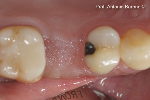 Fig.13 Clinical Occlusal View of healing after 5 months.