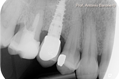 Fig.24 Periapical X-Ray 3 years after implant placement.