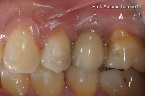 Fig.28 Clinical Buccal view 7 years after implant placement.