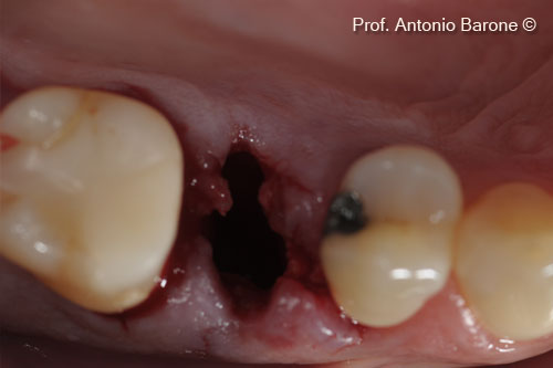 Fig.4 Clinical View of a fresh alveolar socket with a full loss of buccal bone plate