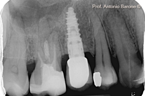Fig.29 Periapical X-Ray 7 years after implant placement.