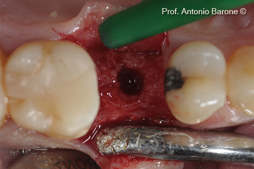 Fig.15 Clinical View of the ridge after 5 months of healing. A bone biopsy was harvested.