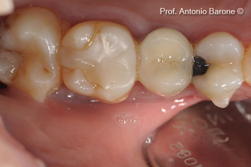 Fig.27 Clinical Occlusal view 7 years after implant placement