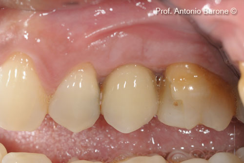 Fig.21 Single Crown 1 year after implant placement.