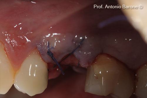 Fig.9 Clinical Buccal View of a OsteoBiol® <i> Derma </i> matrix folded toward the palate and stabilized with resorbable cross-sutures
