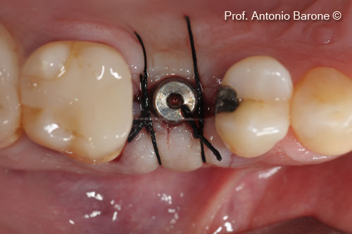 Fig.19 Clinical Occlusal View after implant uncovering 