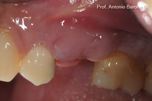 Fig.11 Clinical Buccal View of healing after 10 days.