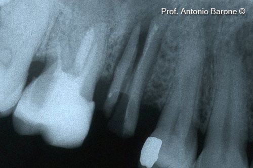 Fig.2 Periapical X-Ray that shows tooth fracture.