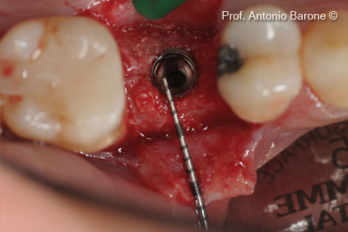 Fig.16 Clinical View of the implant inserted. Measurement of the buccal bone thickness.