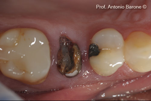 Fig.1 Clinical Occlusal View of a fractured tooth ( #15)