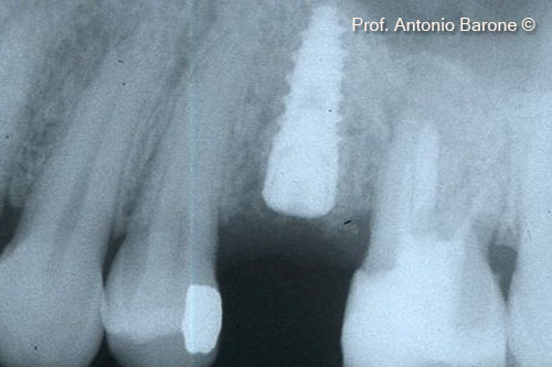 Fig.18 Periapical X-ray with implant placement.