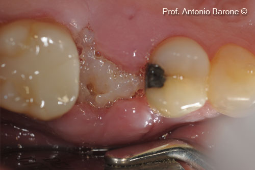 Fig.10 Clinical Occlusal View of healing after 10 days.