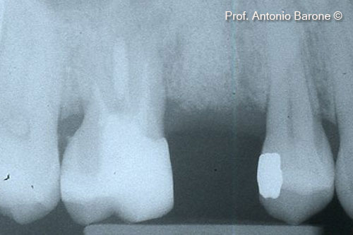 Fig.14 Periapical X-Ray 5 months after grafting.