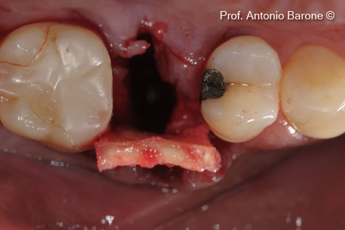 Fig.5 Clinical Occlusal View of a OsteoBiol® <i> Derma </i> matrix inserted at the buccal side with an envelope flap