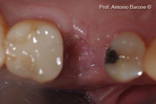Fig.12 Clinical Occlusal View of healing after 2 months.
