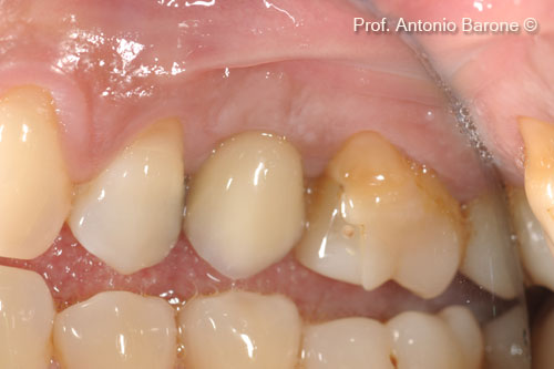 Fig.25 Clinical Buccal view 5 years after implant placement
