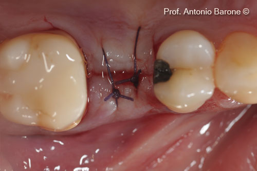 Fig.17 Clinical View of the sutures. 